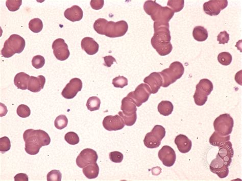 rouleaux formation is seen in